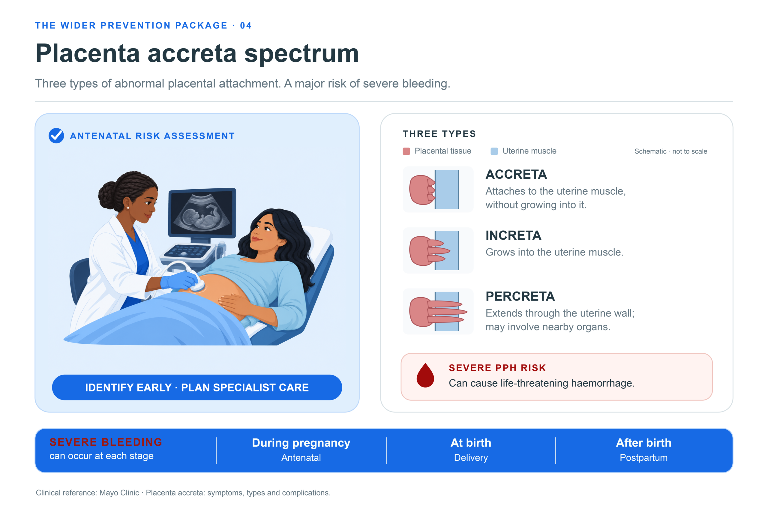 Preventing placenta accreta spectrum